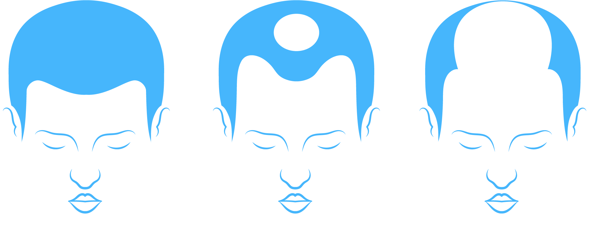 Alopecia masculina y solución con prótesis capilar